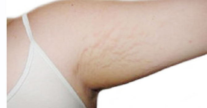 Arm-Stretch-Mark-300x228